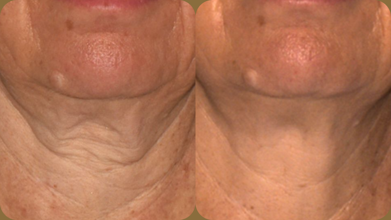 Before and After results